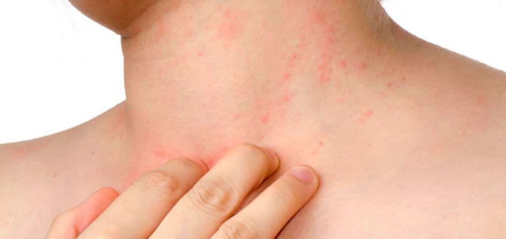 Cuando la dermatitis atópica en la infancia puede anticipar asma y otras enfermedades alérgicas