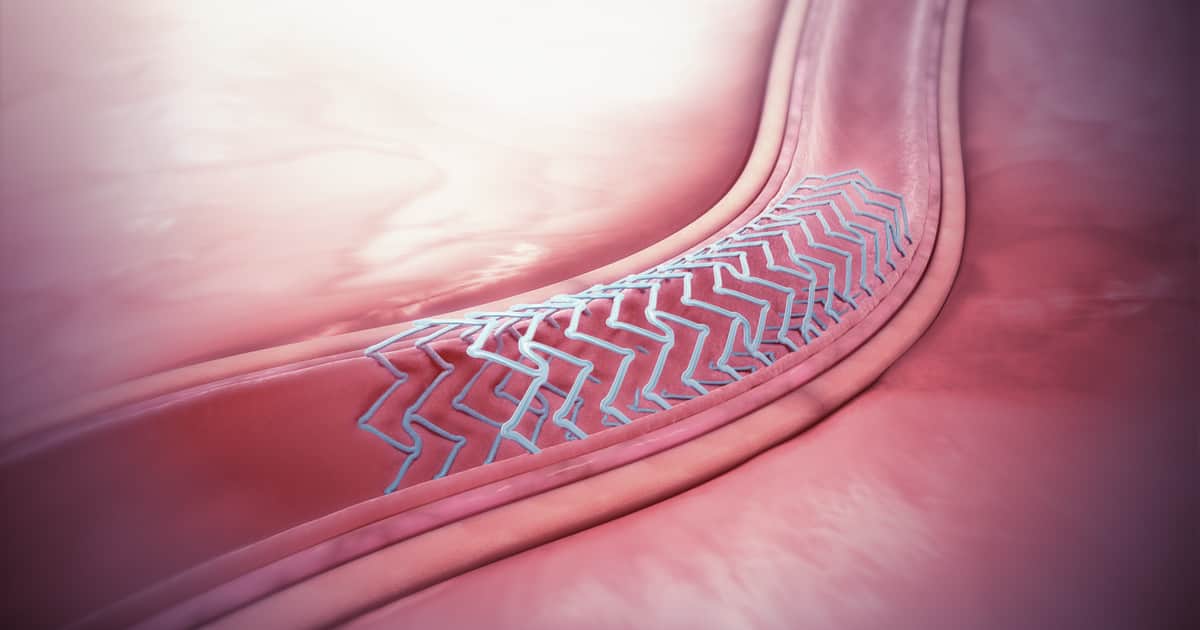 Cirugías cardíacas con stents biodegradables: avanzan pero advierten que para adultos no serían convenientes